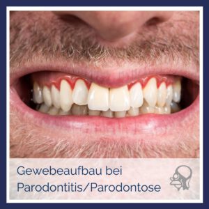 MKG-Chirurgie-Dr-Zikarsky-Nürnberg-Geweberegeneration-bei-Parodontitis-Parodontose