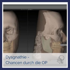 Hier erfahren Sie alles zur Dysgnathie-OP in Nürnberg: Wann ist eine Operation möglich? Was verändert die Operation?